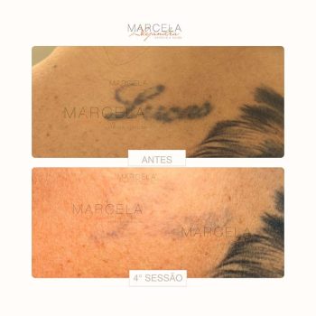 Remoção de tatuagem