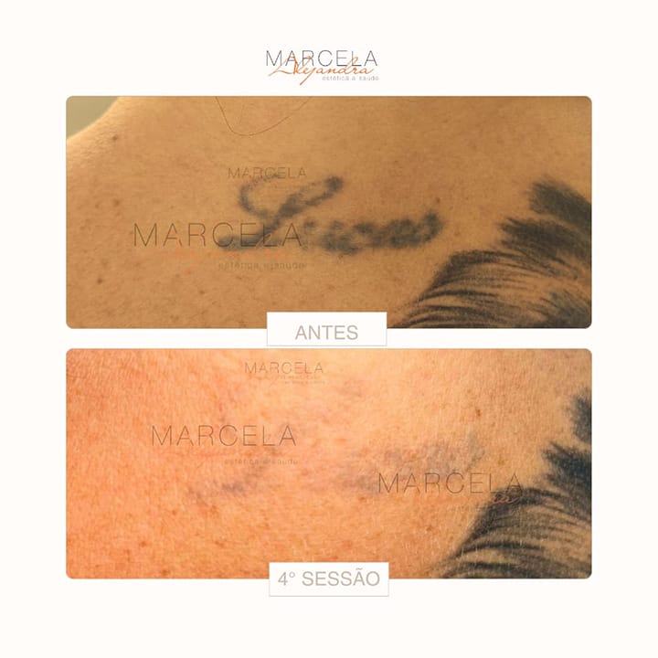 Remoção de tatuagem
